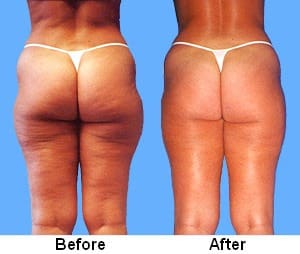 Endermologie: What to Know About the Cellulite Treatment