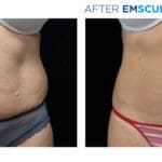 Emsculpt NEO body contouring treatment at Bella MediSpa & Salon in Newton NJ