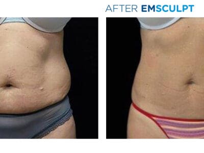 Emsculpt NEO body contouring treatment at Bella MediSpa & Salon in Newton NJ
