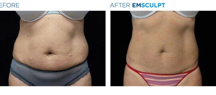 Emsculpt NEO body contouring treatment at Bella MediSpa & Salon in Newton NJ