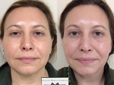 Signature vs Corrective vs Platinum HydraFacial at Bella MediSpa & Salon