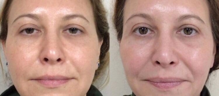Signature vs Corrective vs Platinum HydraFacial at Bella MediSpa & Salon
